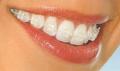 Treatment with Clear Braces